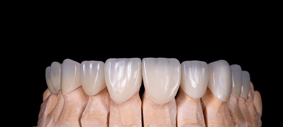Are Dental Crowns Necessary? Transforming Smiles with Confidence