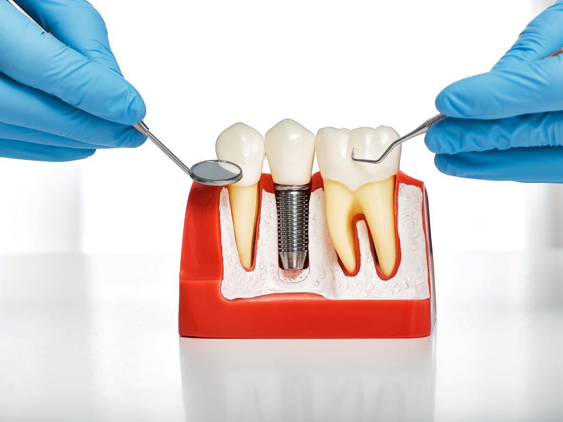 5 Mistakes to Avoid with Dental Implants