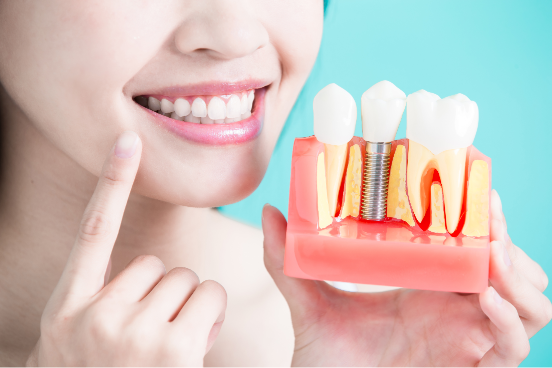 Dental Implants and Benefits