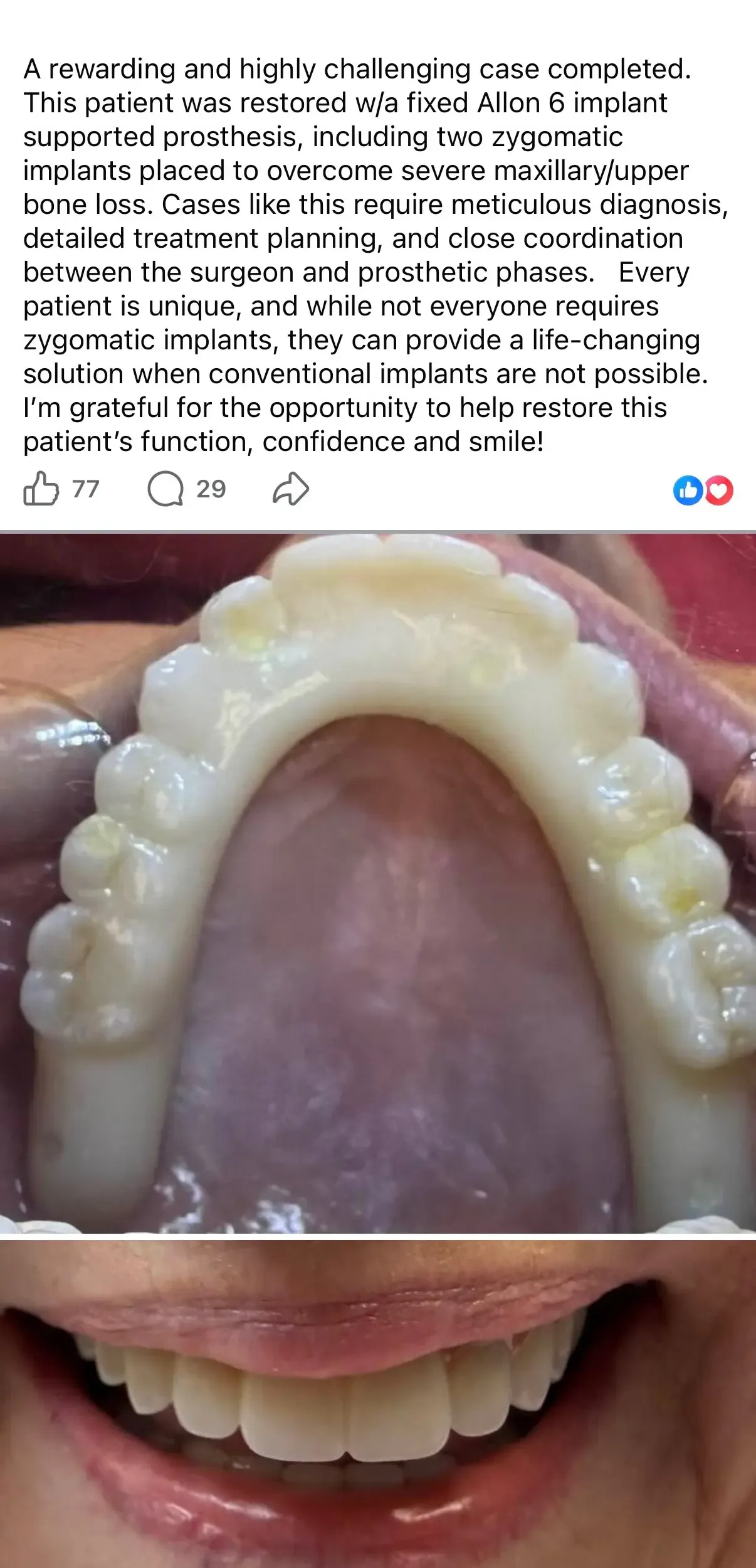 All on X teeth in a day. Successful patient case at 