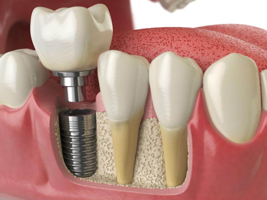 Dental Implants Pittsburgh PA