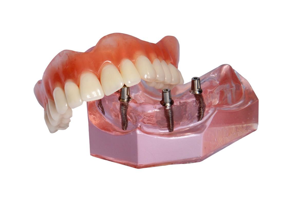 Dental Implants Pittsburgh, PA